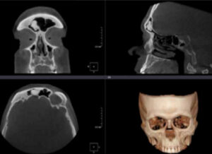 Tomograf A De Macizo Facial Orl Group Ecuador